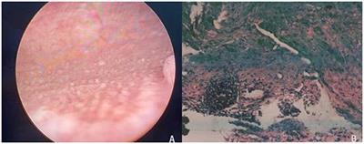 The Efficacy and Safety of Transurethral 2 μm Laser Bladder Lesion Mucosal En Bloc Resection in the Treatment of Cystitis Glandularis